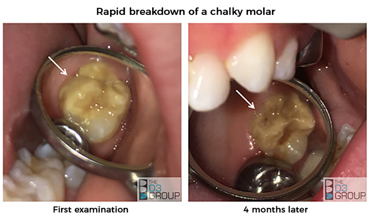 What is Molar Hypomin Rapid Breakdown image